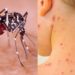 Las otras epidemias en Argentina: hay casi 3 mil casos de dengue y 158 de sarampión De acuerdo al último boletín epidemiológico difundido por el Ministerio de Salud, ya son 2.942 los casos confirmados y probables para dengue en el país, con 6 fallecidos.