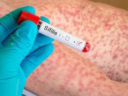 Alerta ya hay más de 55 mil casos de sífilis, el número más alto en cinco años